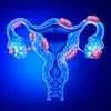 Endometriosis