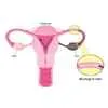 Fallopian-tube-blockage