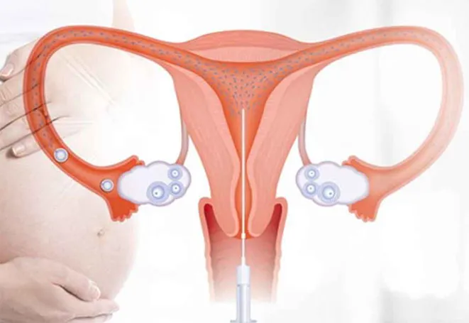 IUI-treatment