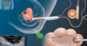Transvaginal Oocyte Retrieval